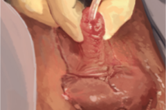 ZSI 100 D4 Semirigid Implant for Metoidioplasty